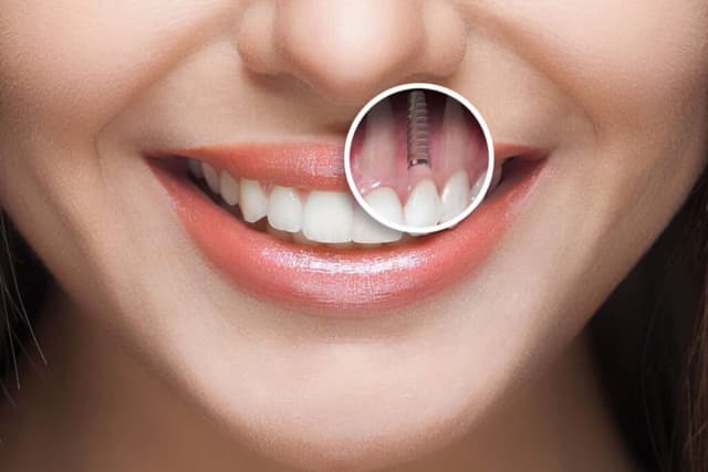 image of Implant showing on a cardati